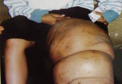 Nyamuk Kaki Gajah Senang Menyerang Kelamin Pria