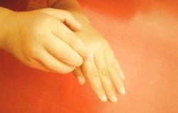 Mati rasa dan Kesemutan