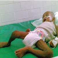 Balita Gizi Buruk di RSD Soewandhie Berisiko Alami Kerusakan Otak 