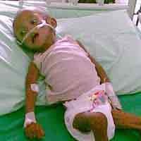 Kondisi Balita Gizi Buruk di RSD Soewandhi Membaik