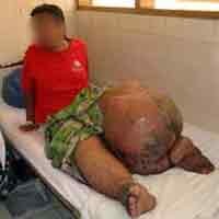 Kabupaten Malang Rawan Teserang Penyakit Kaki Gajah