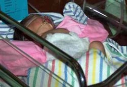 Penyebab Bayi Lahir dengan Usus Terburai