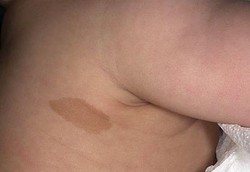 Tanda Lahir Pada Bayi