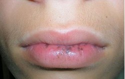  Osler-Weber-Rendu Syndrome