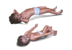 Pertolongan Pertama untuk Anak Sawan