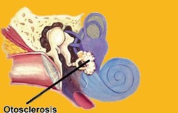 Otosclerosis