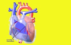 Percarditis