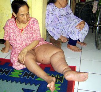 4 Tahun Enok Derita Kaki Gajah