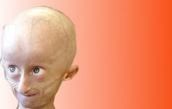 Progeria
