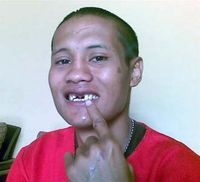 Dihantam Botol, Gigi Petinju Rontok