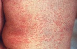 Campak Jerman (Rubella)