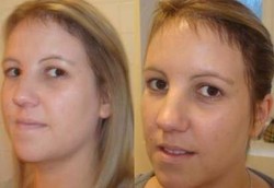 Stres Karena Ingin Kurus Bikin Rambut Rontok