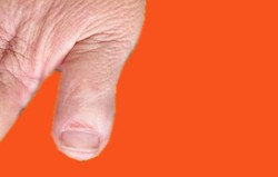 Rubinstein-Taybi Syndrome