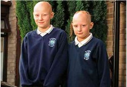 Mahkota Rambut Terenggut Alopecia