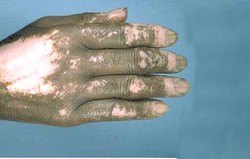  Scleroderma