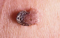 Seborrheic Keratosis 