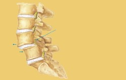 Spondylolysis