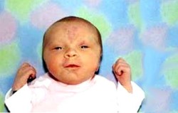 Gigitan Bangau (Tanda Lahir)