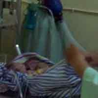 Membiru, Kembar Siam Dempet Perut Probolinggo Distabilkan