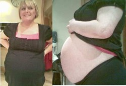 Dikira Hamil Tak Tahunya Ada Kista Seberat 7 Kg