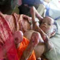 Gangguan Auto Imun, Sekujur Tubuh Wijayanto Melepuh