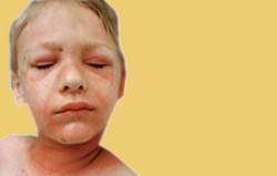 Sindrom Kulit Tersiram Air Panas