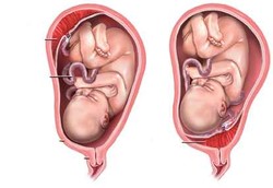 Perhatikan Letak Plasenta Janin Saat Hamil