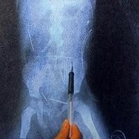 40 Jarum Bersarang di Dalam Tubuh Anak 2 Tahun!