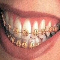 Harga Emas Meroket, Banyak Orang Jual Kawat Gigi Emas