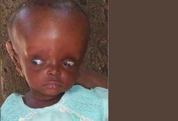 Peneliti UGM Temukan Alat Terapi Hidrosefalus Berbiaya Murah