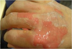 Luka Bakar Jangan Diolesi Odol atau Minyak