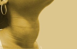 Gondok Nodular Toxic