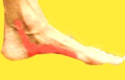 Disfungsi Saraf Tibialis