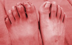 Thromboangiitis Obliterans