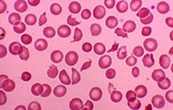 Thrombotic thrombocytopenic purpura (TTP)