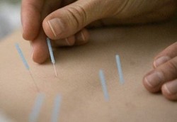 Gatal Alergi Hilang Dengan Akupuntur