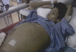 Berjuang Melawan Kanker Tulang Langka