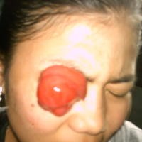 9 Tahun Magfiroh Derita Tumor Ganas di Mata