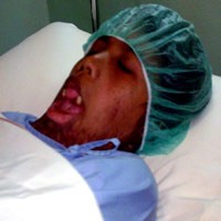 Tujuh Jam Jalani Operasi, Santi Dapat Gerakkan Lehernya