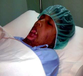 Santi Korban KDRT Dioperasi