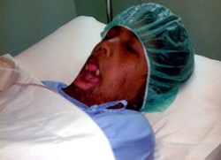 Usai Jalani Operasi Bibir, Santi Sudah Bisa Minum Pakai Sedotan