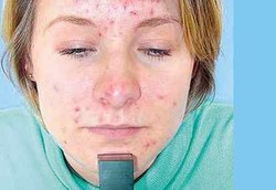 Penyakit Kulit Picu Gangguan Kejiwaan