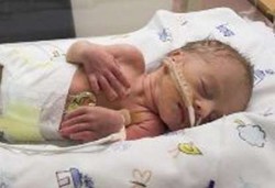 Bayi Lahir Prematur Meningkat Drastis