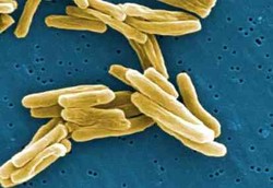 Mudahnya Penularan TBC 