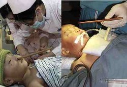 Hidung Bocah Kemasukan Sumpit yang Tembus Hingga Otak Depan