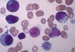 Vaksin untuk Menghancurkan Sisa Sel Kanker