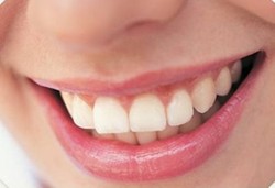 Kikir Gigi dan Risikonya 