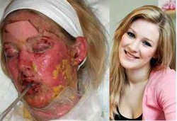 Wajah Sembuh Setelah Rusak Total Kena Alergi Parasetamol