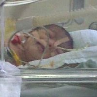 RS Kariadi Operasi Bayi Tanpa Dinding Perut