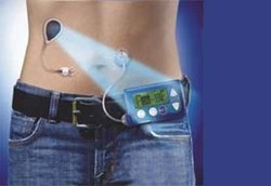 Pankreas Buatan untuk Diabetes Tipe 1